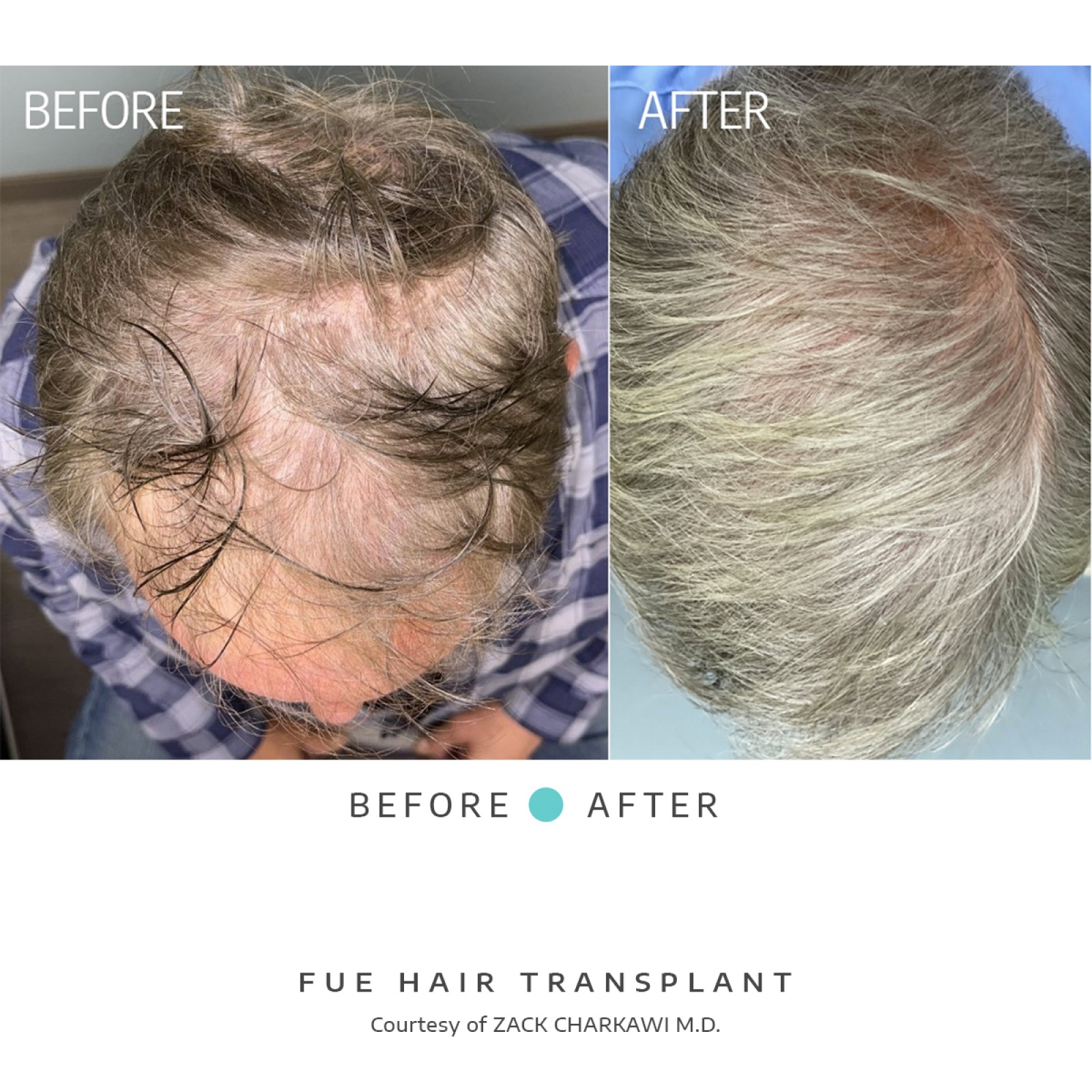 The before image reveals balding and thinning hair on a man's head. The after image displays luxuriant, natural-looking hair regrowth as a result of a hair transplant.