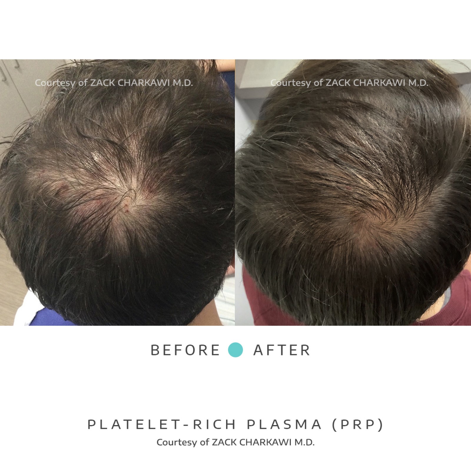 On the left image, a close-up view reveals noticeable hair thinning, with scalp becoming more visible due to the lack of density. In contrast, the right image presents a significant transformation, displaying thick and healthier-looking hair. The once-thinning areas now appear full and voluminous, showcasing the effectiveness of the treatment in restoring hair density and promoting overall hair health.