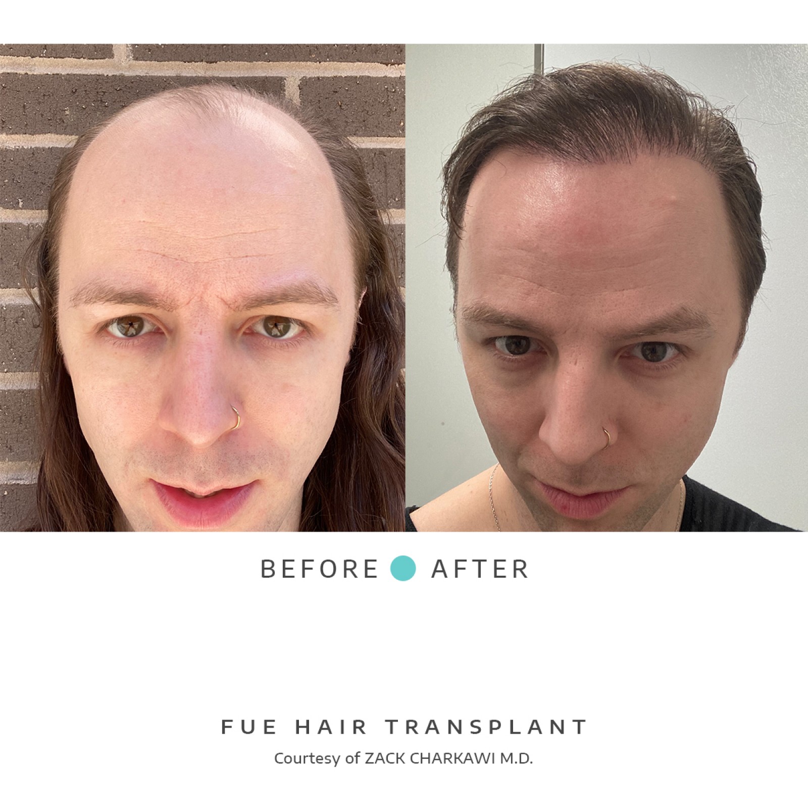A before image shows balding and thinning hair with visible scalp patches. The after shows a successful hair transplant, the scalp is now covered with dense, natural-looking hair.