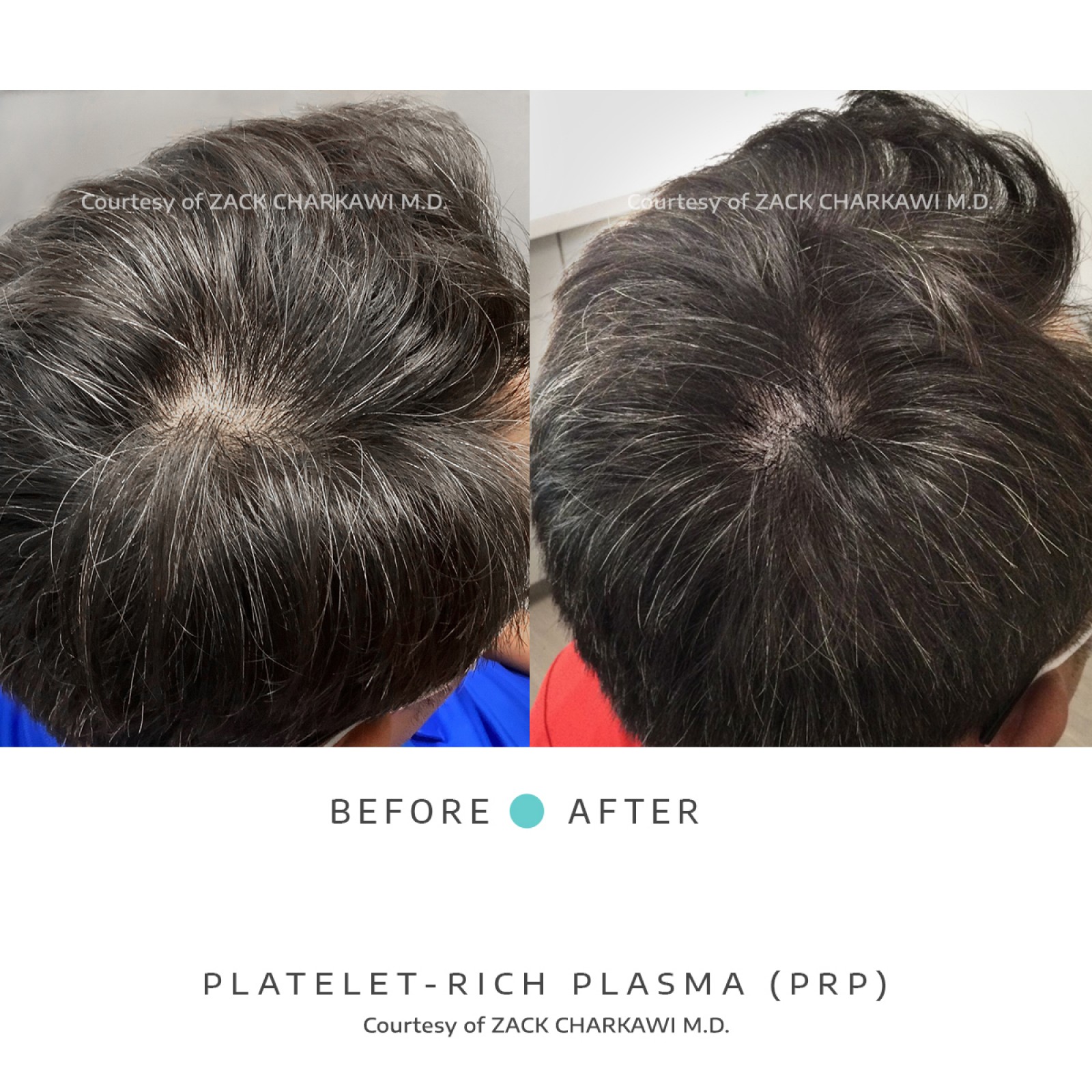 On the left image, a close-up view reveals noticeable hair thinning, with scalp becoming more visible due to the lack of density. In contrast, the right image presents a significant transformation, displaying thick and healthier-looking hair. The once-thinning areas now appear full and voluminous, showcasing the effectiveness of the treatment in restoring hair density and promoting overall hair health.