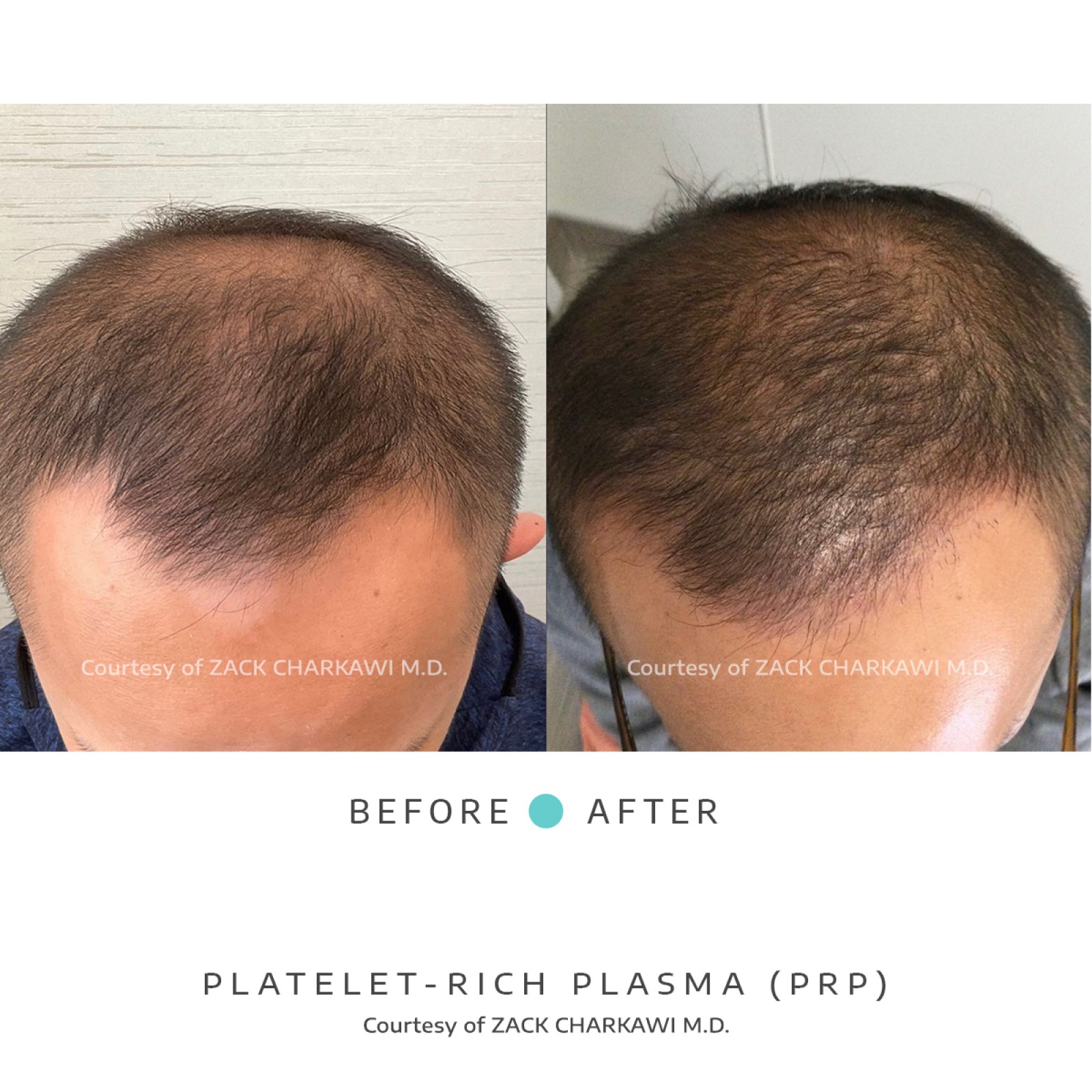 On the left image, a close-up view reveals noticeable hair thinning, with scalp becoming more visible due to the lack of density. In contrast, the right image presents a significant transformation, displaying thick and healthier-looking hair. The once-thinning areas now appear full and voluminous, showcasing the effectiveness of the treatment in restoring hair density and promoting overall hair health.