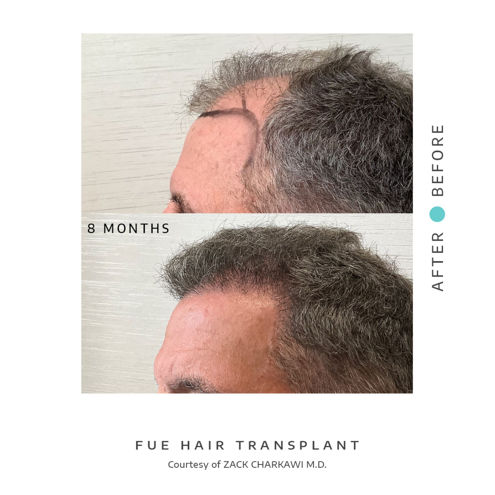 In the left image, a close-up reveals significant balding and thinning hair on a man's head, with visible scalp patches indicating notable hair loss. Conversely, the right image highlights the dramatic outcome of a successful hair transplant procedure. Now, the previously barren scalp displays a luxuriant, natural-looking hair growth, skillfully masking previous bald patches and evoking a sense of fullness and revitalization.