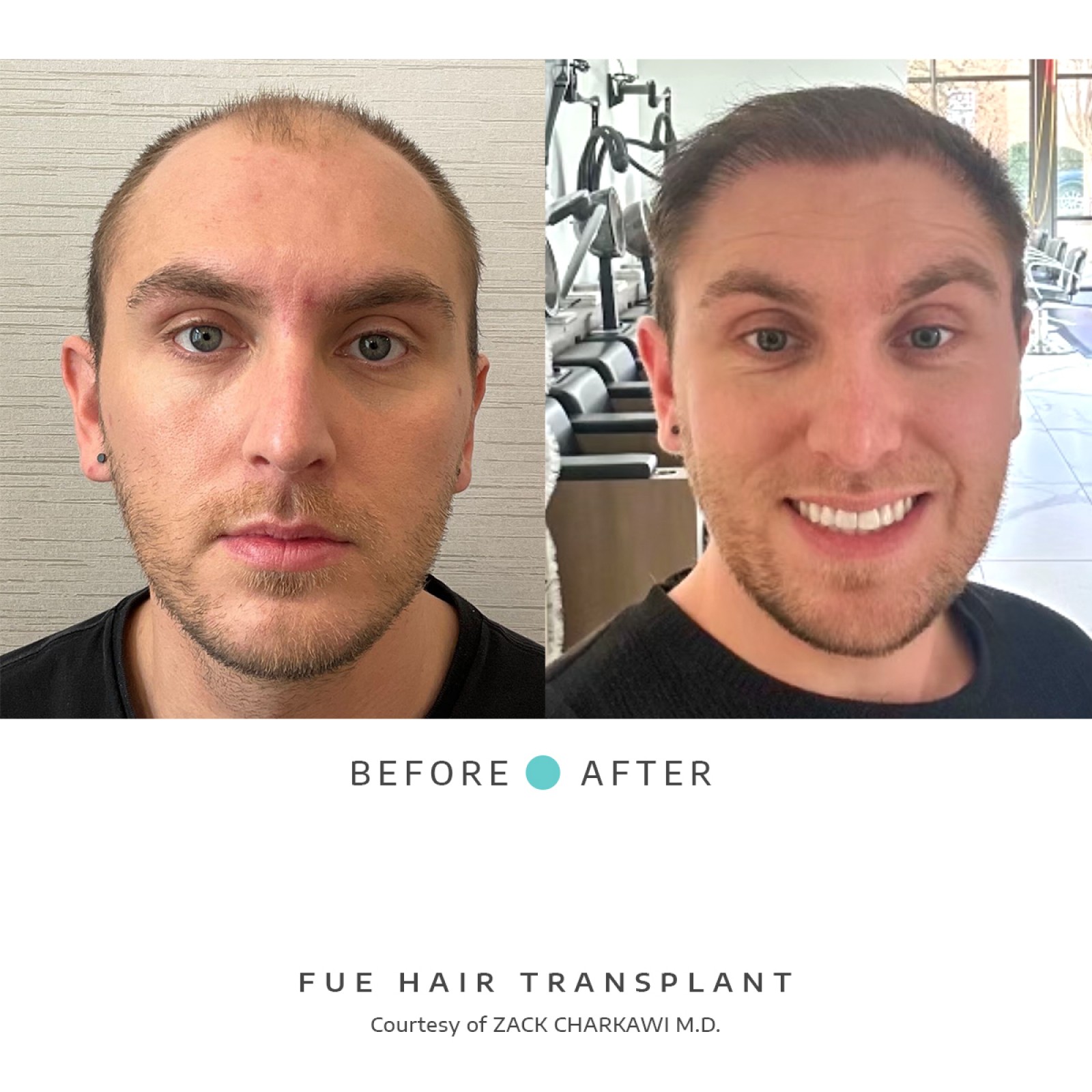The before image depicts balding and thinning hair with visible scalp patches, while the after image illustrates a successful FUE hair transplant with the scalp now covered in dense, natural-looking hair.