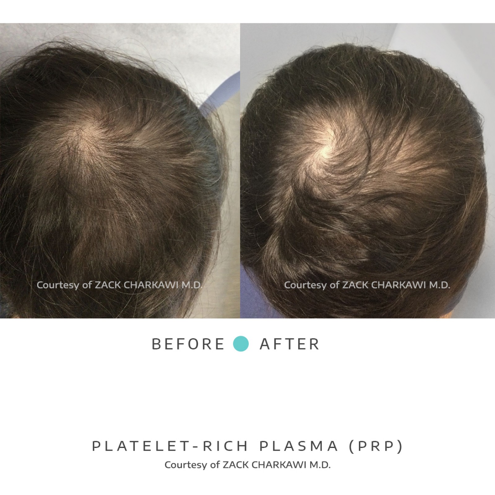 On the left image, a close-up view of the crown of the head reveals noticeable hair thinning, with the scalp becoming more visible due to the lack of density. In contrast, the right image presents a significant transformation, displaying thick and healthier-looking hair. The once-thinning areas now appear full and voluminous, showcasing the effectiveness of the treatment in restoring hair density and promoting overall hair health.
