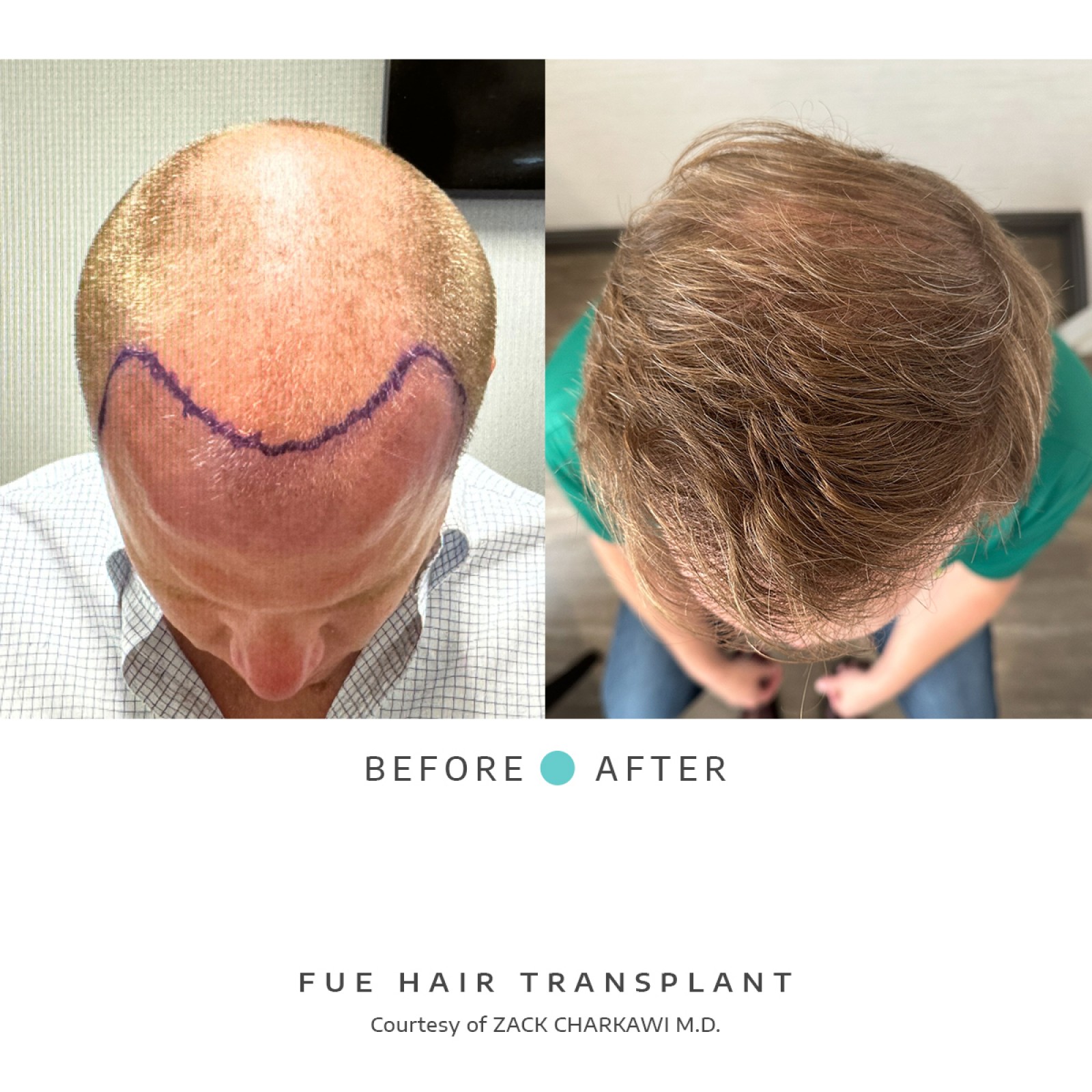 The before image shows balding and thinning hair with visible scalp patches. The after image shows a successful hair transplant with the scalp now covered in dense, natural-looking hair.