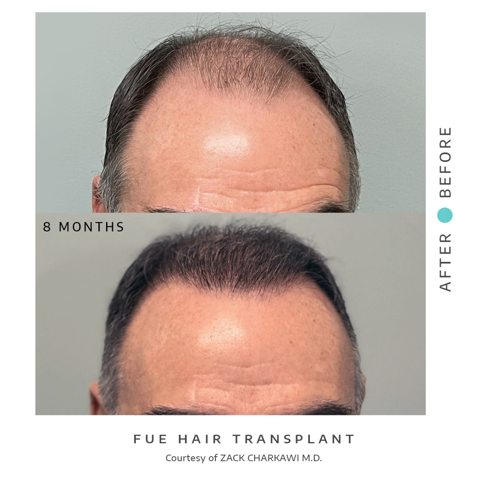 The before image shows balding and thinning hair with visible scalp patches. The after image shows a successful hair transplant with the scalp now covered in dense, natural-looking hair.