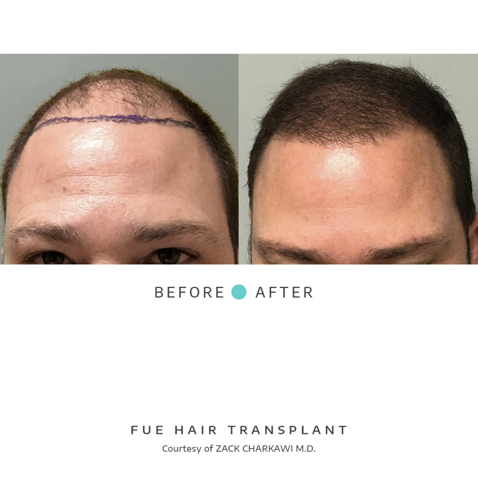 The before image shows balding and thinning hair of a man, while the after image depicts a successful FUE hair transplant with the scalp now with natural-looking hair.