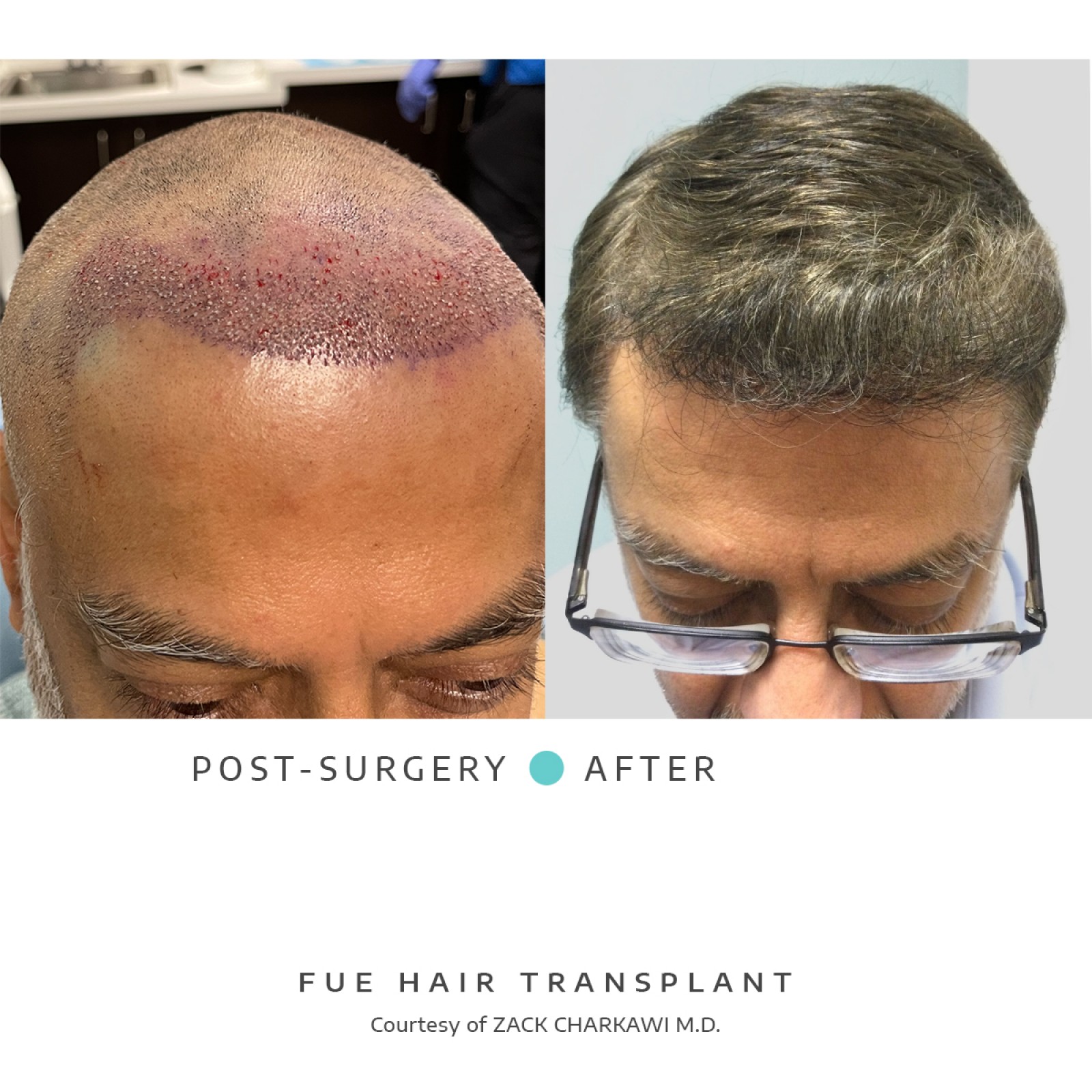 The before image shows a close-up of a man's scalp with hair loss. The left image reveals the freshly transplanted area after a hair transplant, with lush, natural-looking hair concealing previous bald patches.
