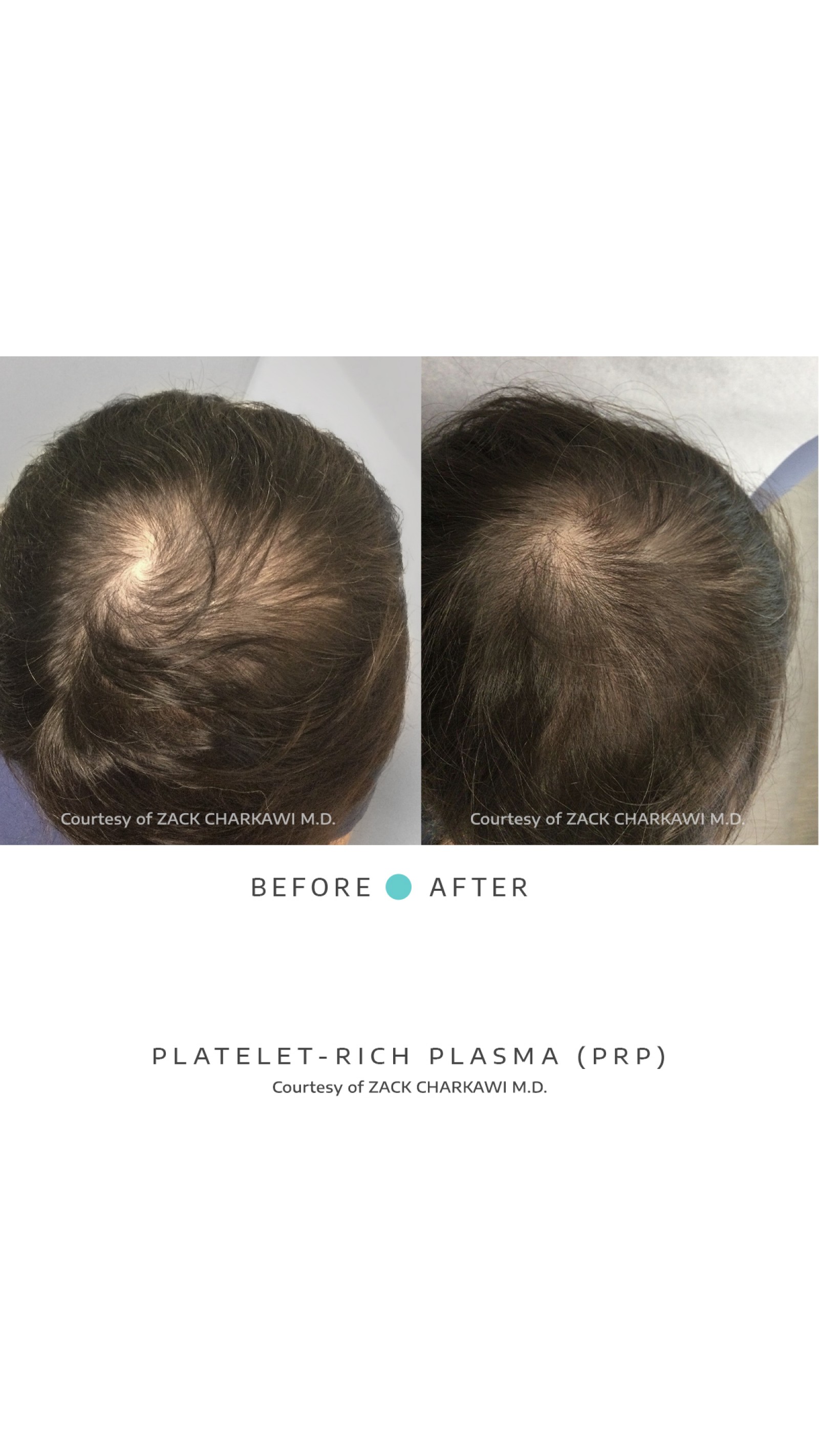 On the left image, a close-up view of the crown of the head reveals noticeable hair thinning, with the scalp becoming more visible due to the lack of density. In contrast, the right image presents a significant transformation, displaying thick and healthier-looking hair. The once-thinning areas now appear full and voluminous, showcasing the effectiveness of the treatment in restoring hair density and promoting overall hair health.