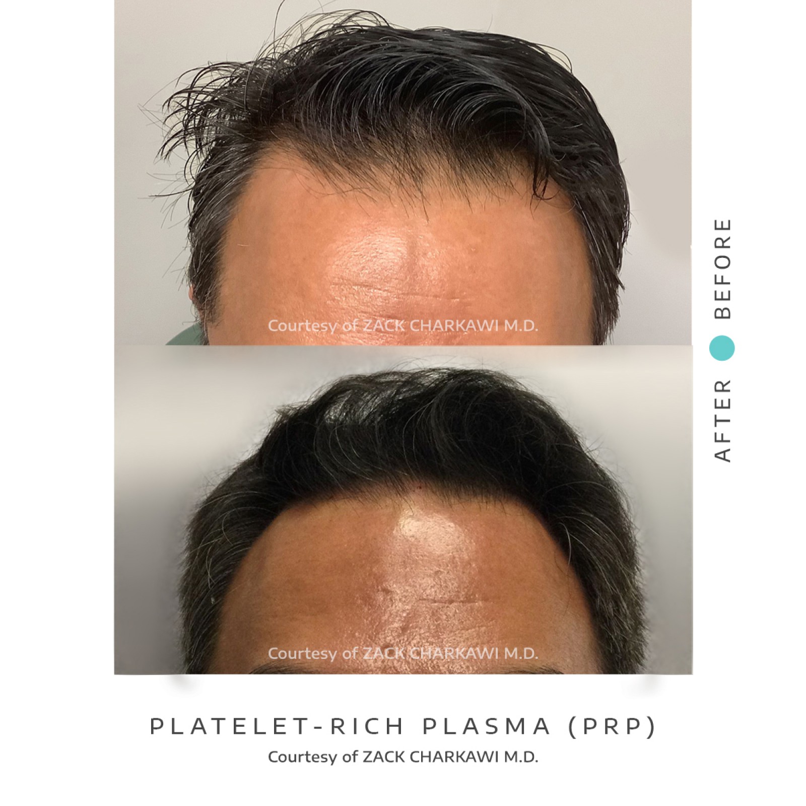 On the left image, a close-up view reveals noticeable hair thinning, with scalp becoming more visible due to the lack of density. In contrast, the right image presents a significant transformation, displaying thick and healthier-looking hair. The once-thinning areas now appear full and voluminous, showcasing the effectiveness of the treatment in restoring hair density and promoting overall hair health.