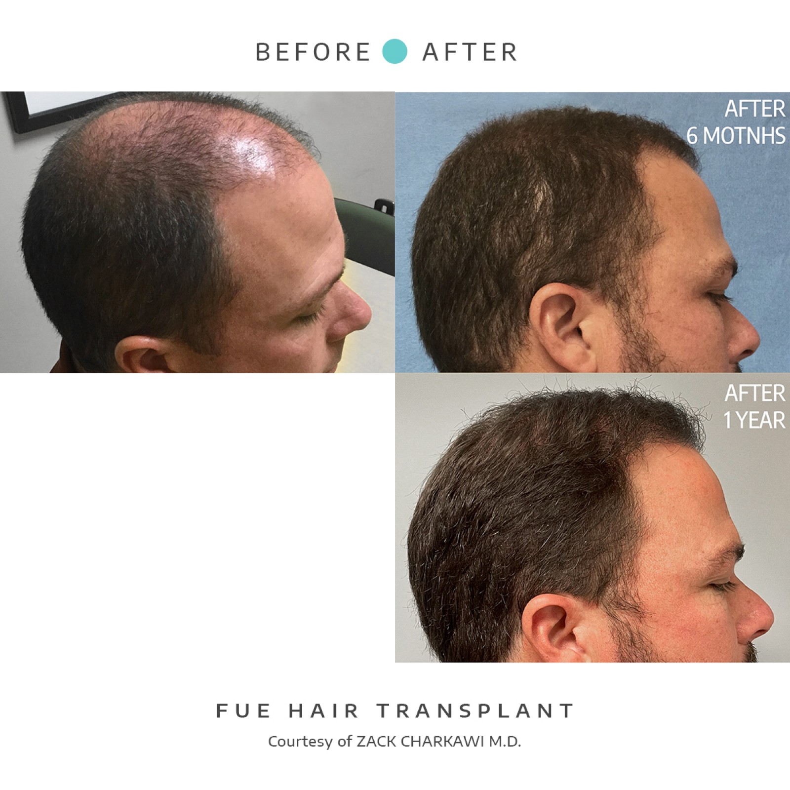 The before image shows a close-up of the scalp of a man suffering from hair loss, while the after image depicts a successful FUE hair transplant with thick and natural-looking hair.