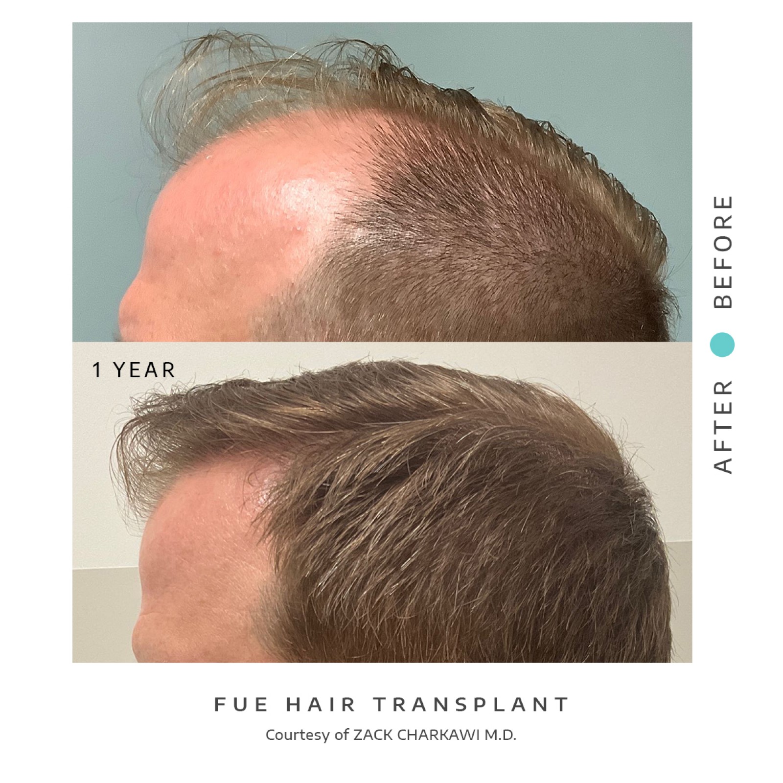 The before image depicts balding and thinning hair with visible scalp patches. The after image illustrates a successful hair transplant with the scalp now covered in dense, natural-looking hair.