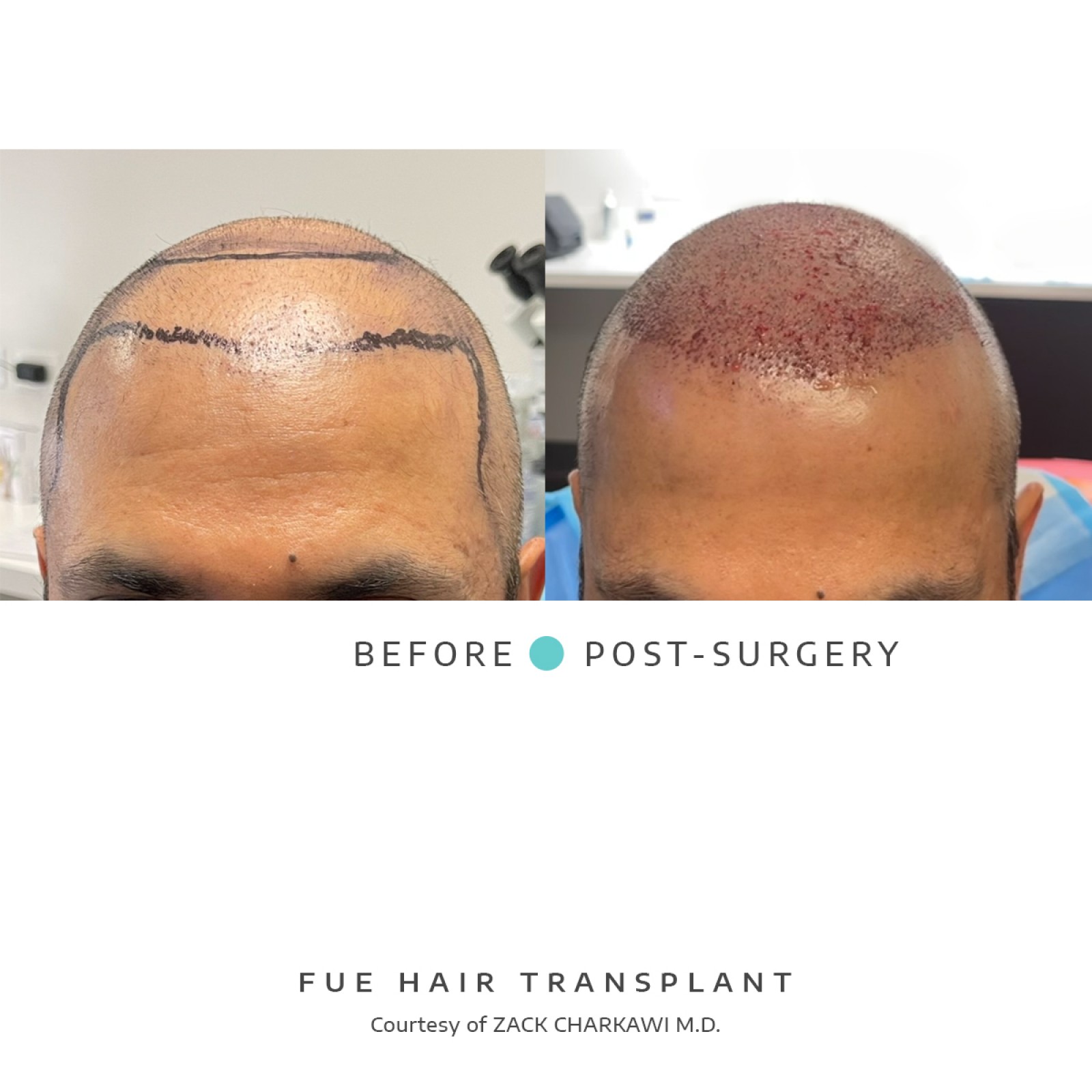 The before image shows a close-up of a man's scalp with hair loss. The after image reveals the freshly transplanted area after a hair transplant, with lush, natural-looking hair concealing previous bald patches.