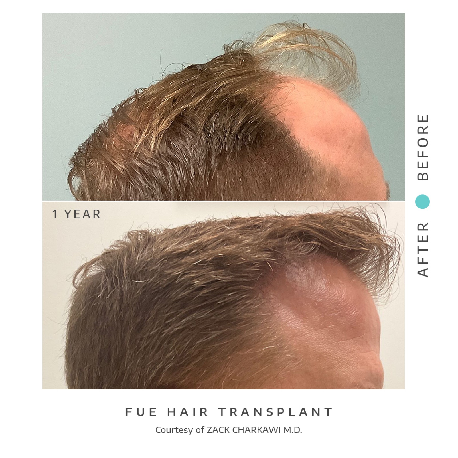 The before image shows balding and thinning hair with visible scalp patches. The after image shows a successful fue hair transplant with the scalp now covered in dense, natural-looking hair.