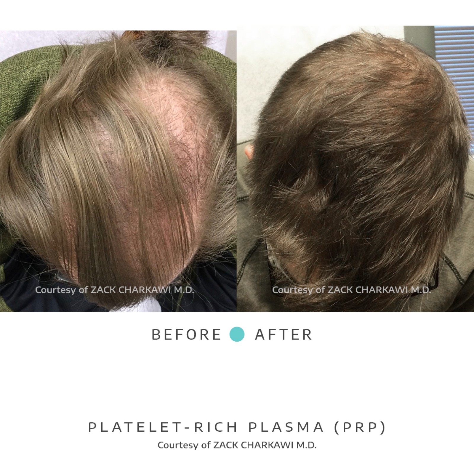 On the left image, a close-up view reveals noticeable hair thinning, with scalp becoming more visible due to the lack of density. In contrast, the right image presents a significant transformation, displaying thick and healthier-looking hair. The once-thinning areas now appear full and voluminous, showcasing the effectiveness of the treatment in restoring hair density and promoting overall hair health.