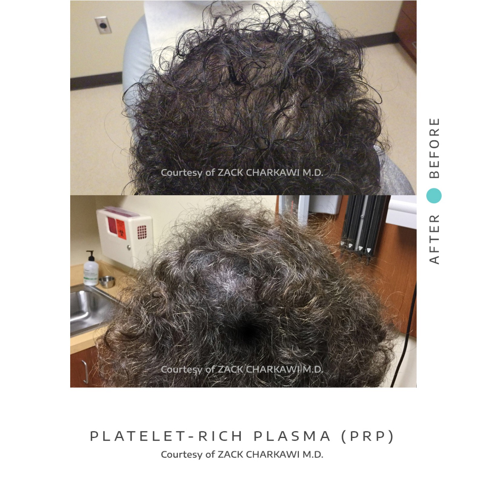 On the left image, a close-up view reveals noticeable hair thinning, with scalp becoming more visible due to the lack of density. In contrast, the right image presents a significant transformation, displaying thick and healthier-looking hair. The once-thinning areas now appear full and voluminous, showcasing the effectiveness of the treatment in restoring hair density and promoting overall hair health.