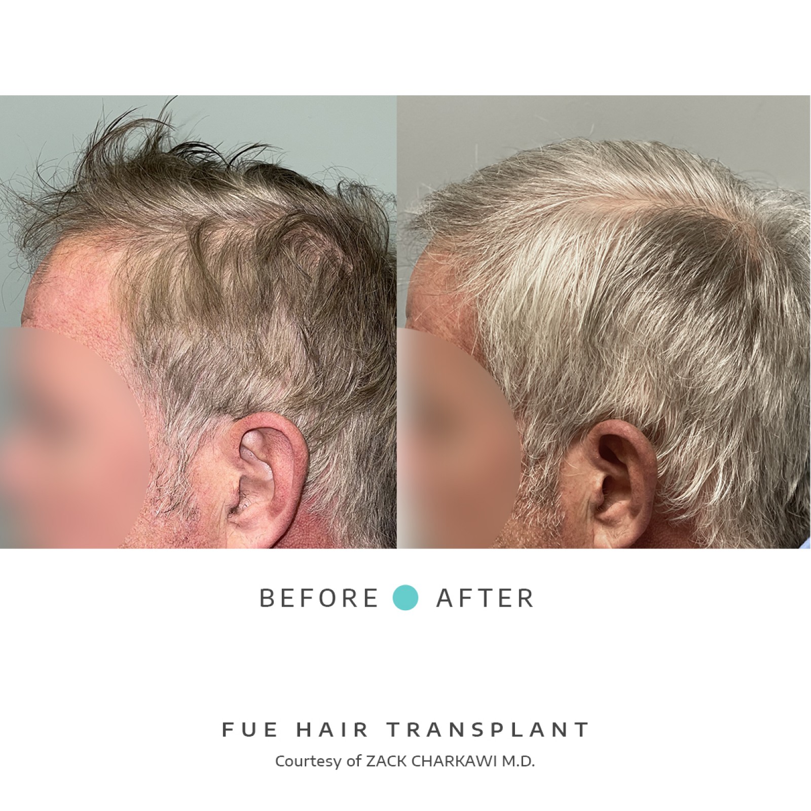 The before image reveals balding and thinning hair on a man's head. The after image displays luxuriant, natural-looking hair regrowth as a result of a hair transplant.