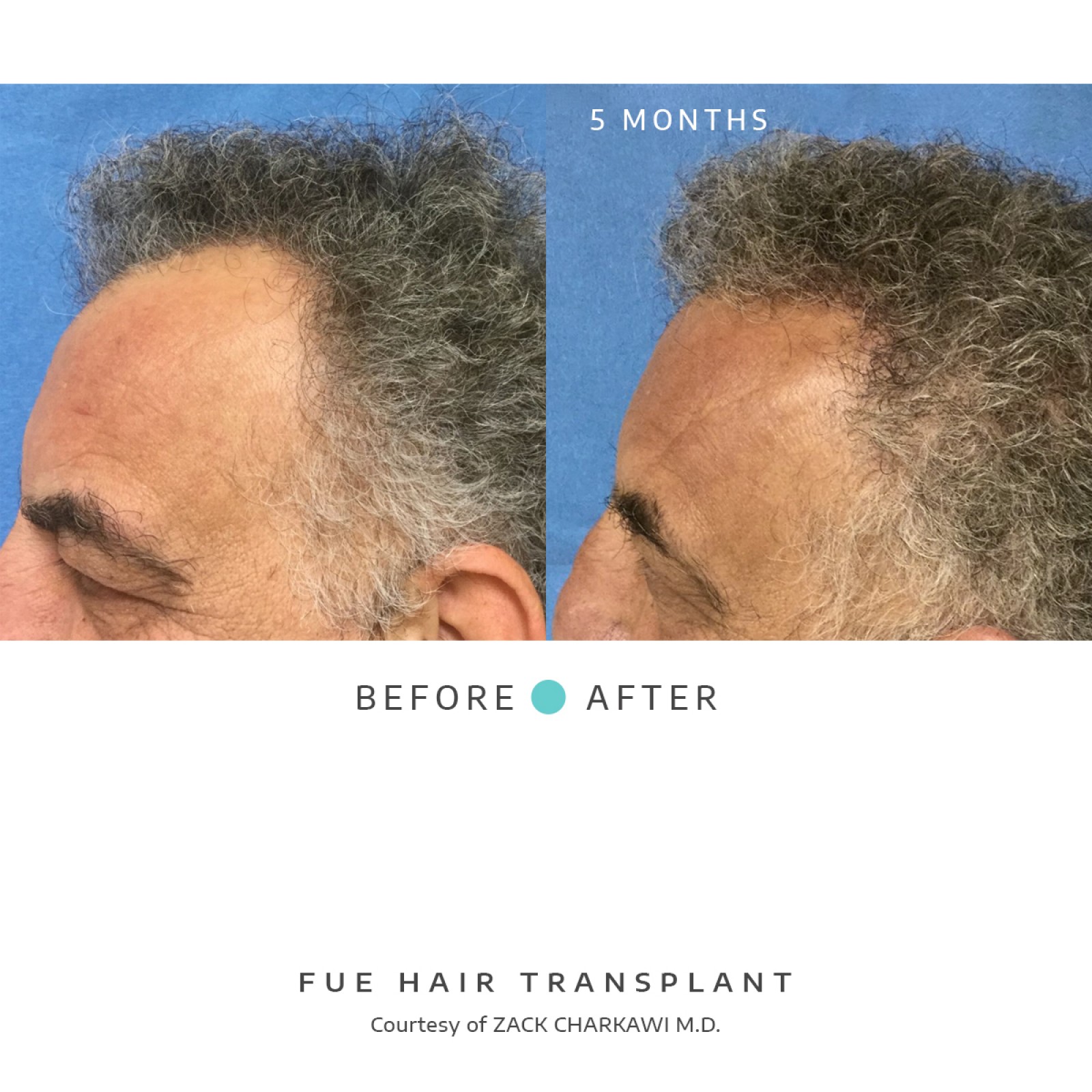 The left image, a close-up profile of a man, reveals thinning hair. The after image shows a restored hairline displaying natural-looking growth as a result of a successful transplant.