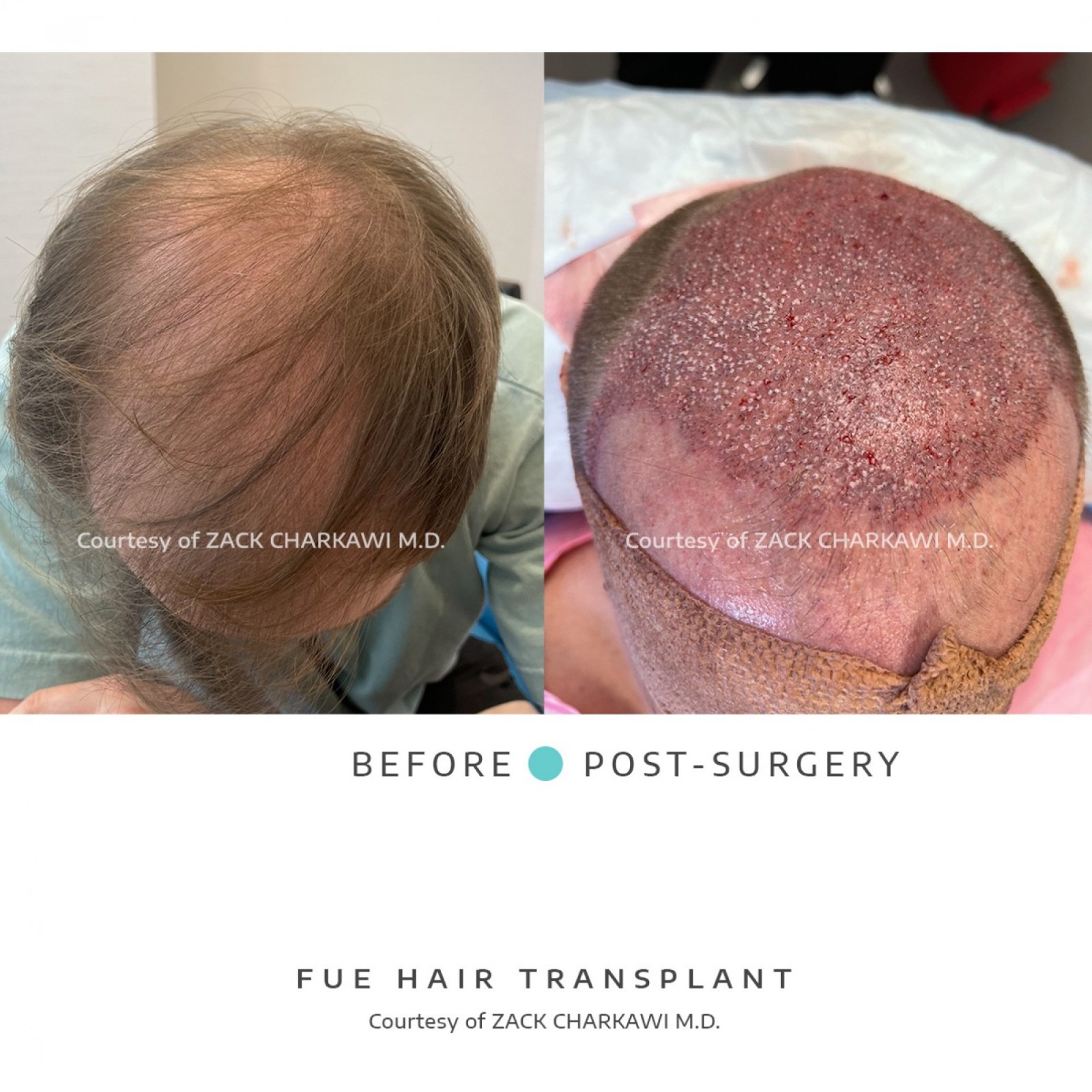 The left image, a close-up profile of a man, reveals thinning hair. The after image shows a restored hairline displaying natural-looking growth as a result of a successful transplant.