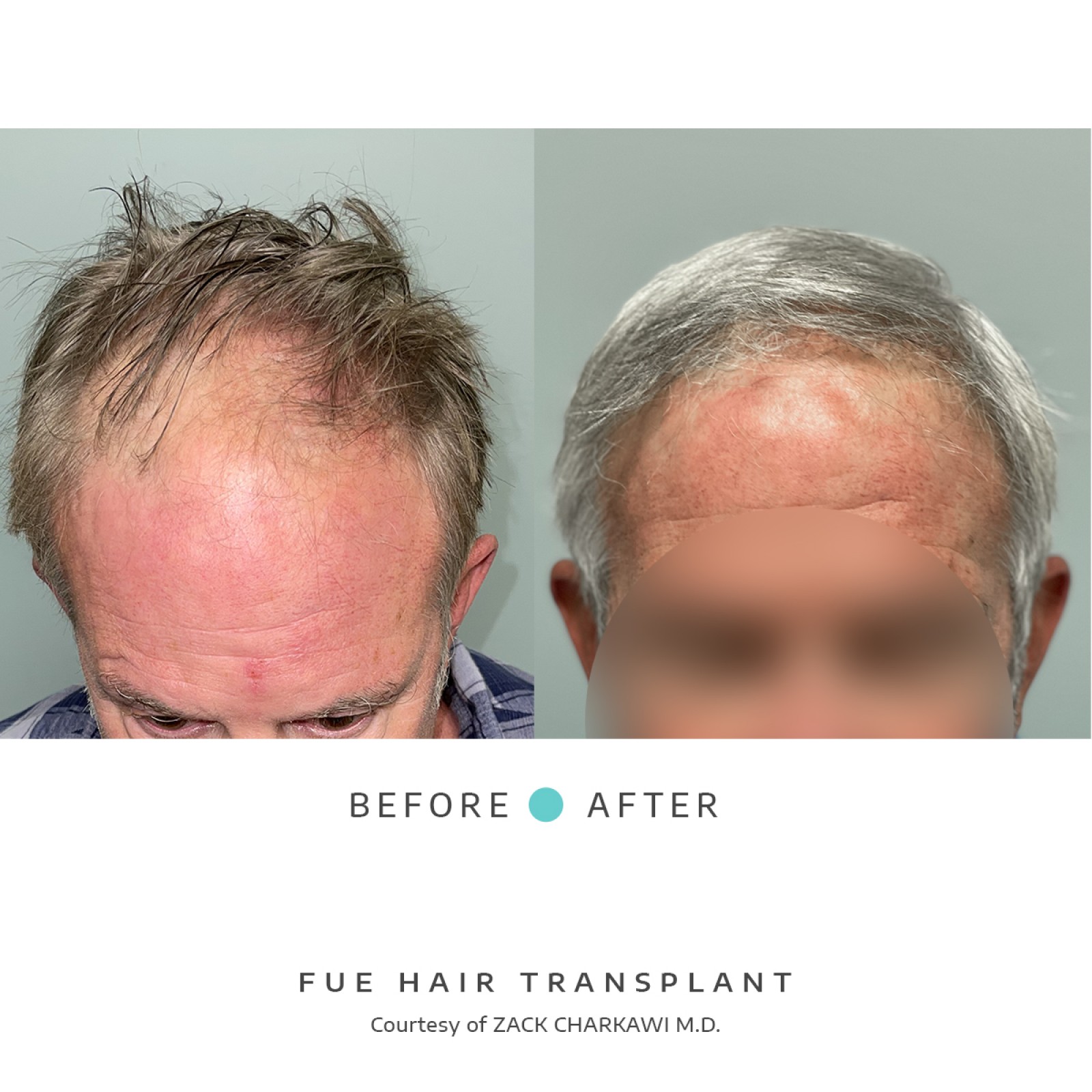 Left image  reveals significant balding and thinning hair on a man's head, . Conversely, the right image highlights the dramatic outcome of a successful hair transplant procedure. 