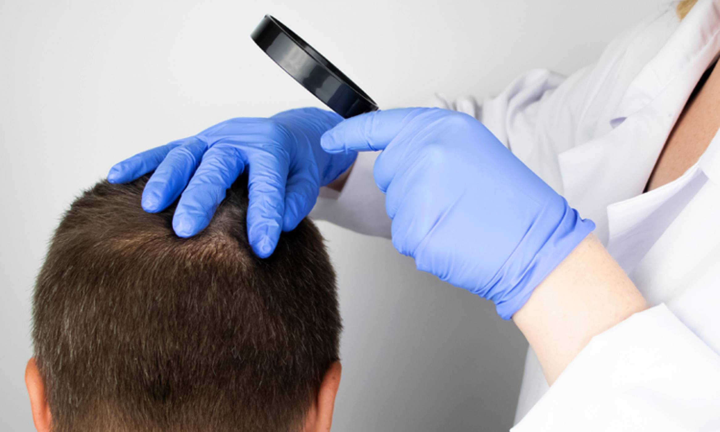 A close-up of a doctor examining the scalp of a man using a magnifier to treat any hair loss or balding patches he suffers from