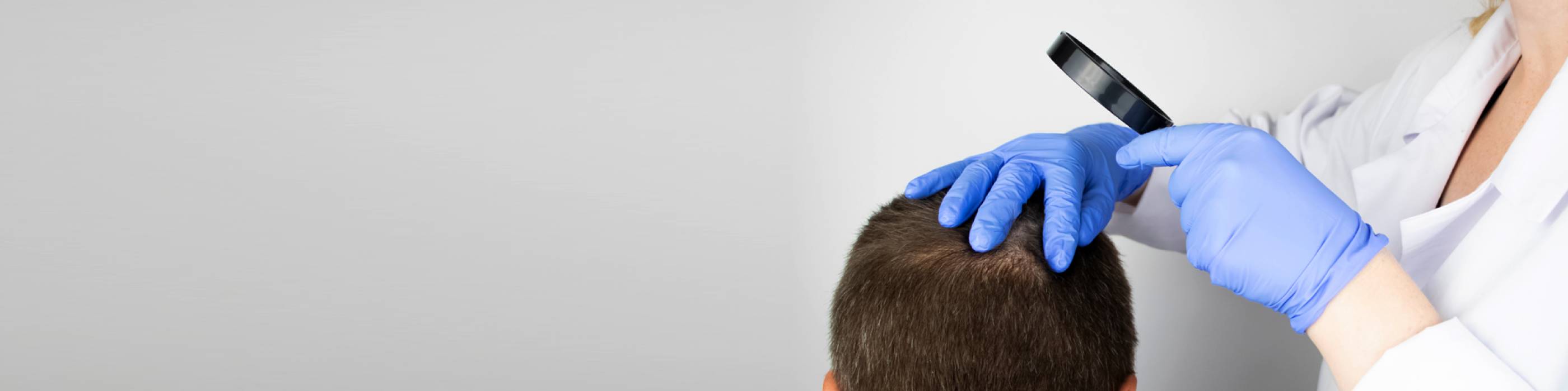 A close-up of a doctor examining the scalp of a man using a magnifier to treat any hair loss or balding patches he suffers from