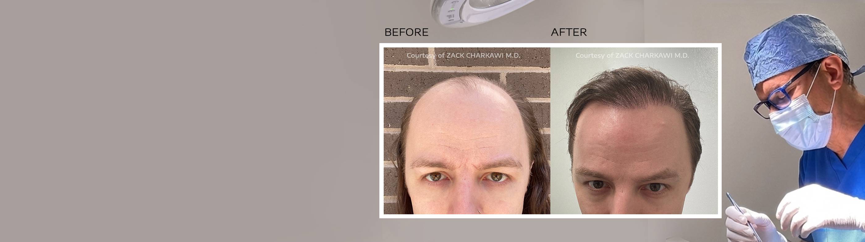 Confident man in suit outdoors, symbolizing natural results from a hair transplant in Atlanta.