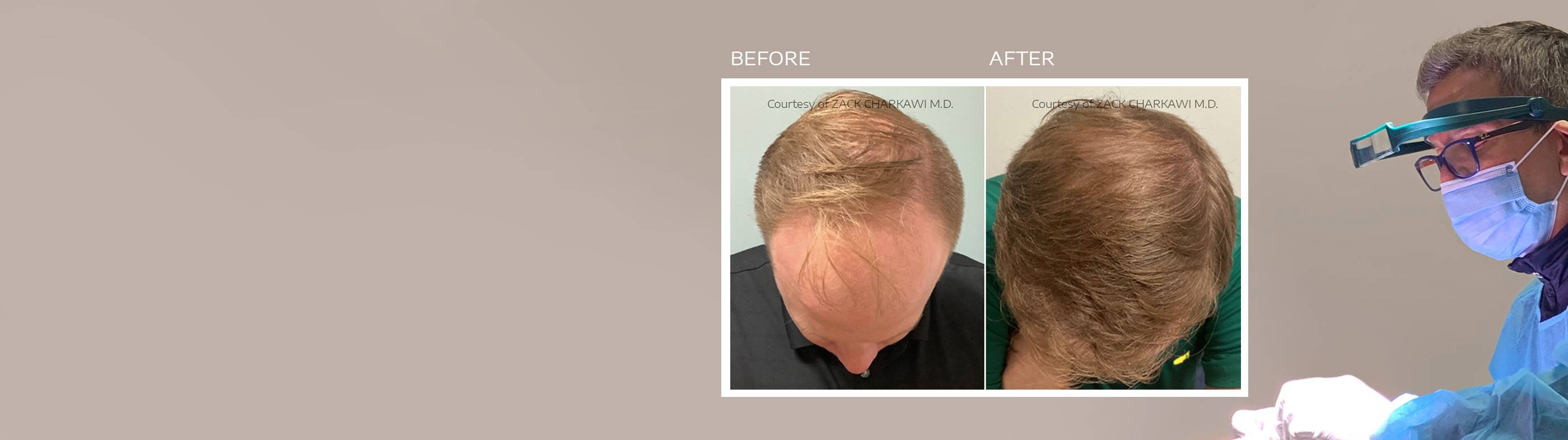 FUE (Follicular Unit Extraction)