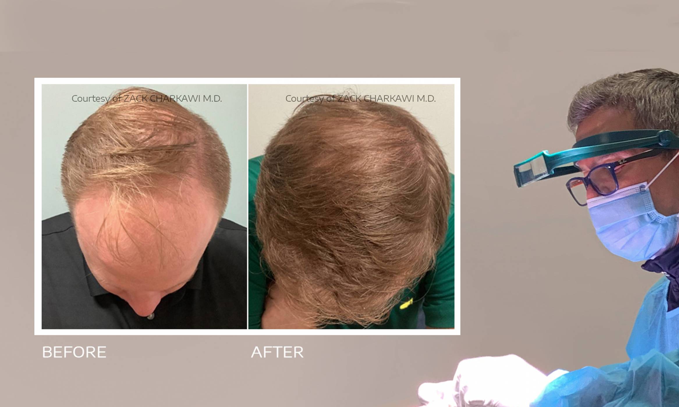 FUE (Follicular Unit Extraction)