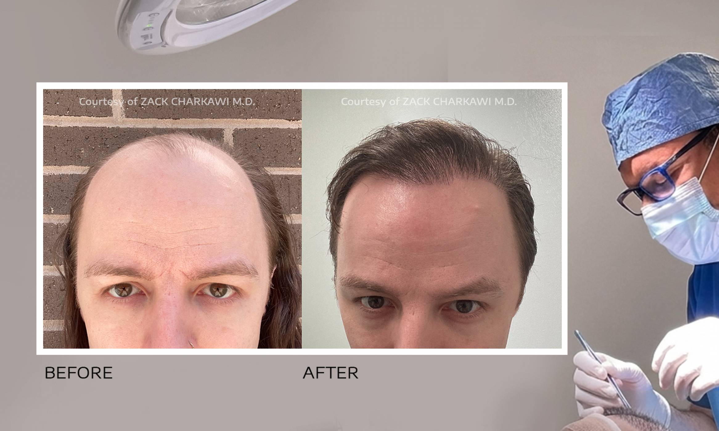 Confident man in suit outdoors, symbolizing natural results from a hair transplant in Atlanta.