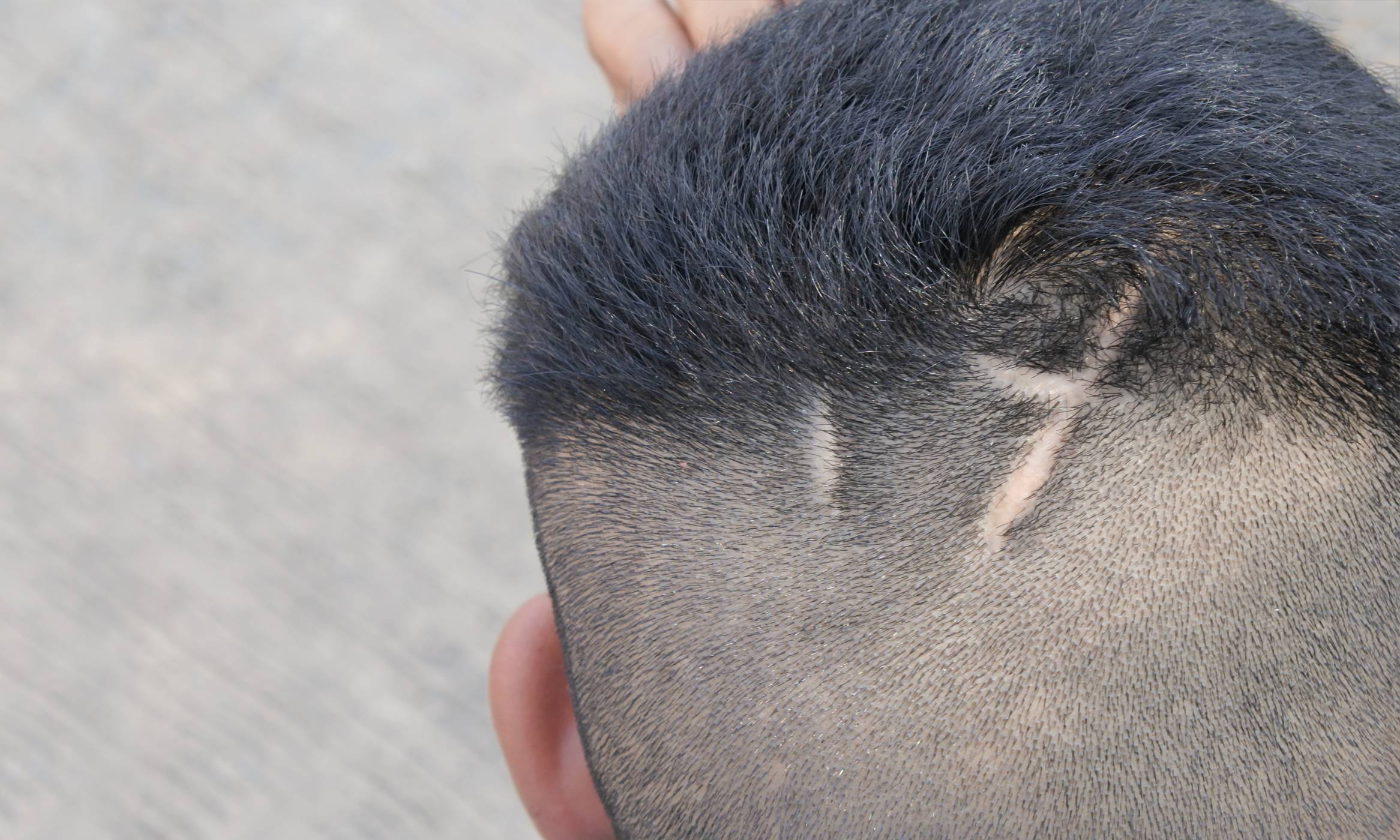 Close-up of a man’s scalp, who is a good candidate for scar revision either through treatment or hair transplant procedure