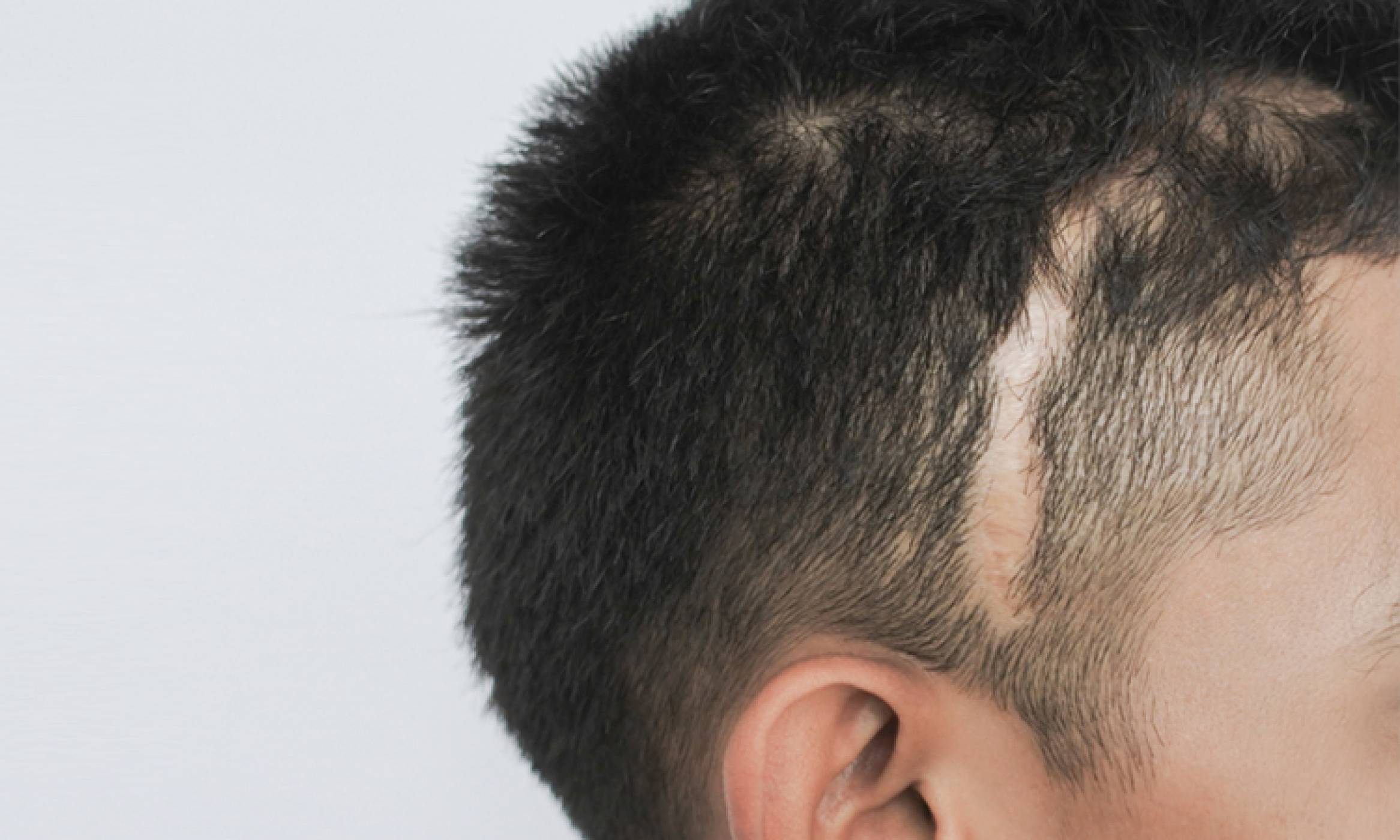 Close-up on a man's head with short hair, showing a large scar across his scalp, making him a good candidate for a scar revision procedure