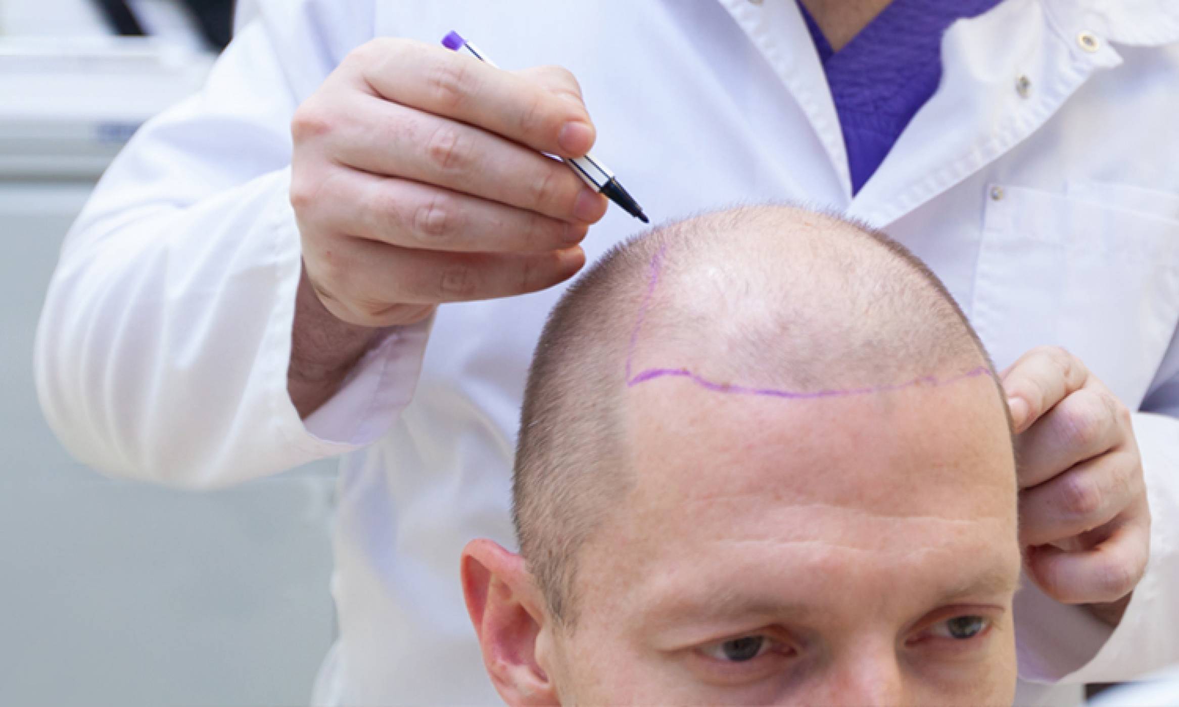 Physician marking where the transplants will be performed on a man suffering from hair loss as a solution for his condition.
