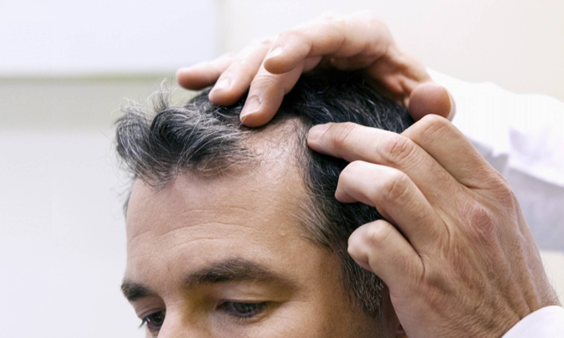Close-up of the scalp of a man with a receding hairline as a physician examines during a hair transplant consultation.