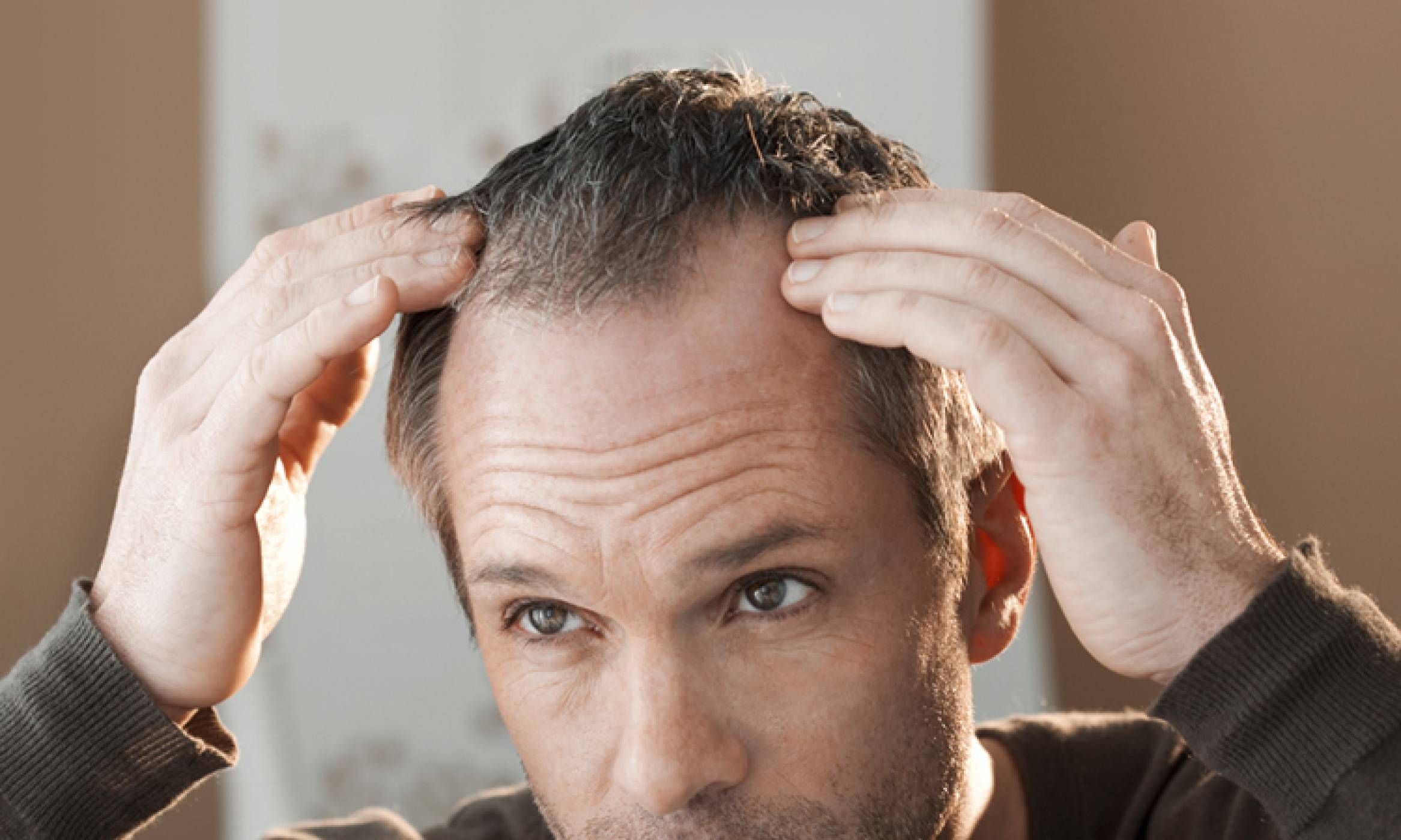 A man in his forties points at his receding hairline with both hands, highlighting the roots of his hair.