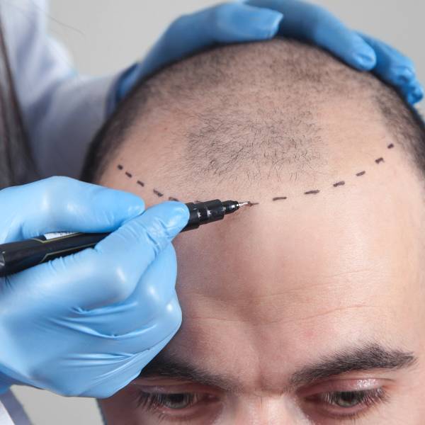 Why Choose an FUE Transplant?