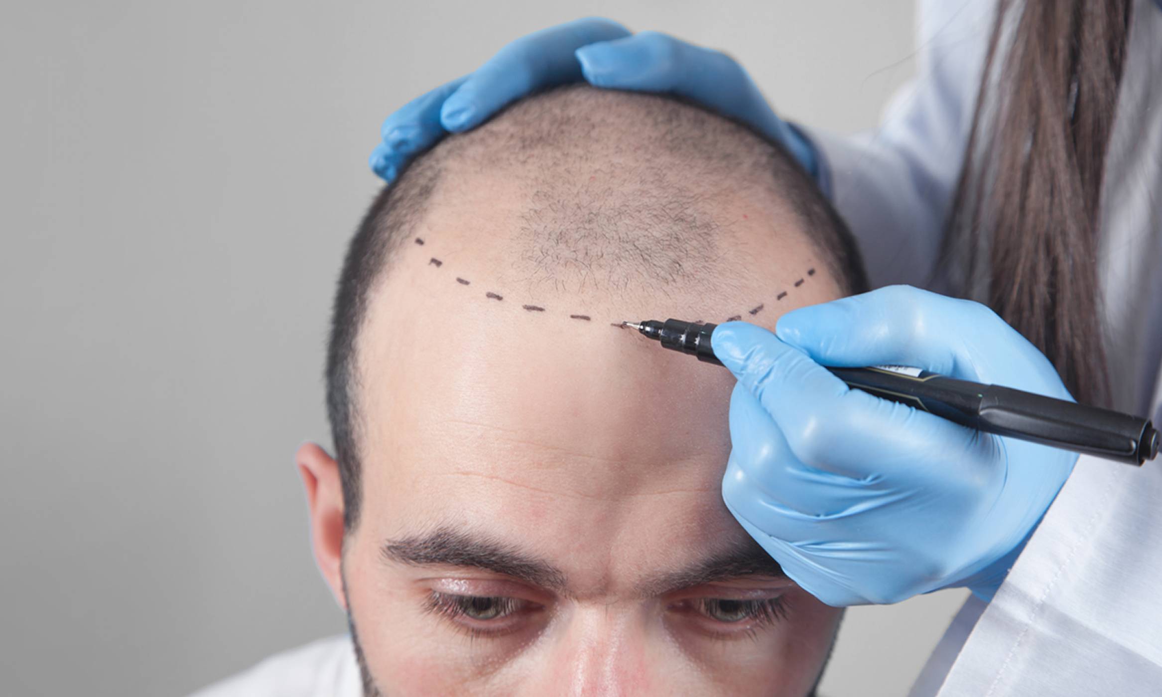 Physician marking where the transplants will be performed on a man suffering from hair loss as a solution for his condition.