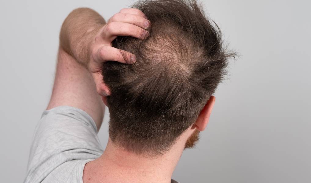 Early Hair Loss: Causes, Effects, and Treatment Options