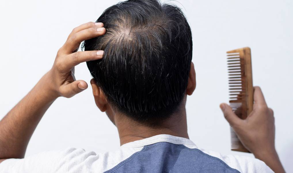 Indian Hair Restoration: Understanding Hair Loss Through a Cultural Lens