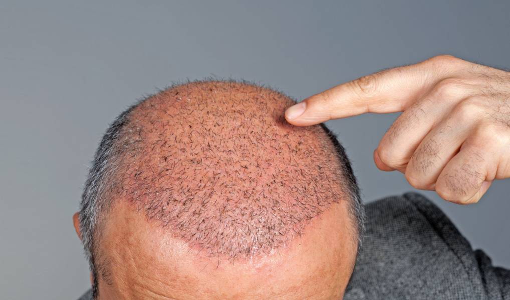 Hair Transplants: Myths, Modern Techniques, and What to Expect