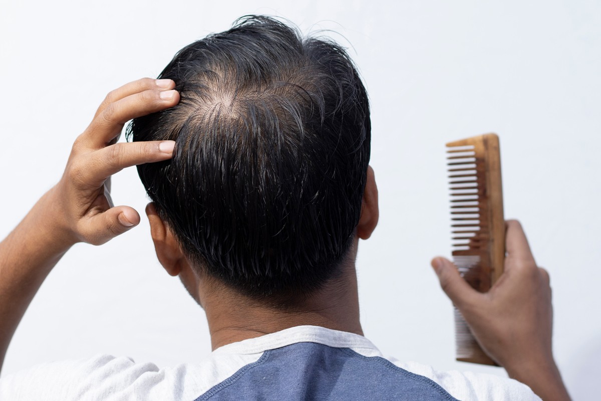 Indian man examining a thinning crown (male pattern hair loss) while holding a comb — Indian hair restoration guide