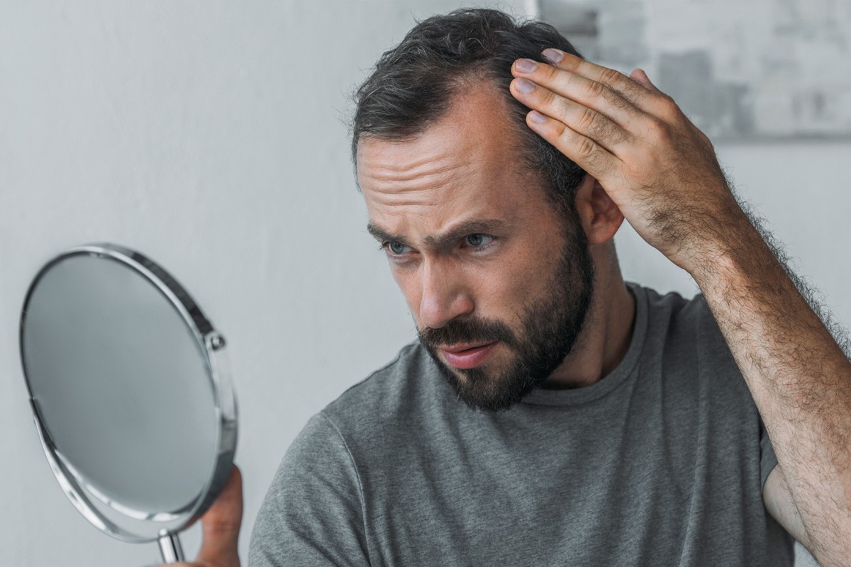 Man examining a receding hairline in the mirror due to DHT