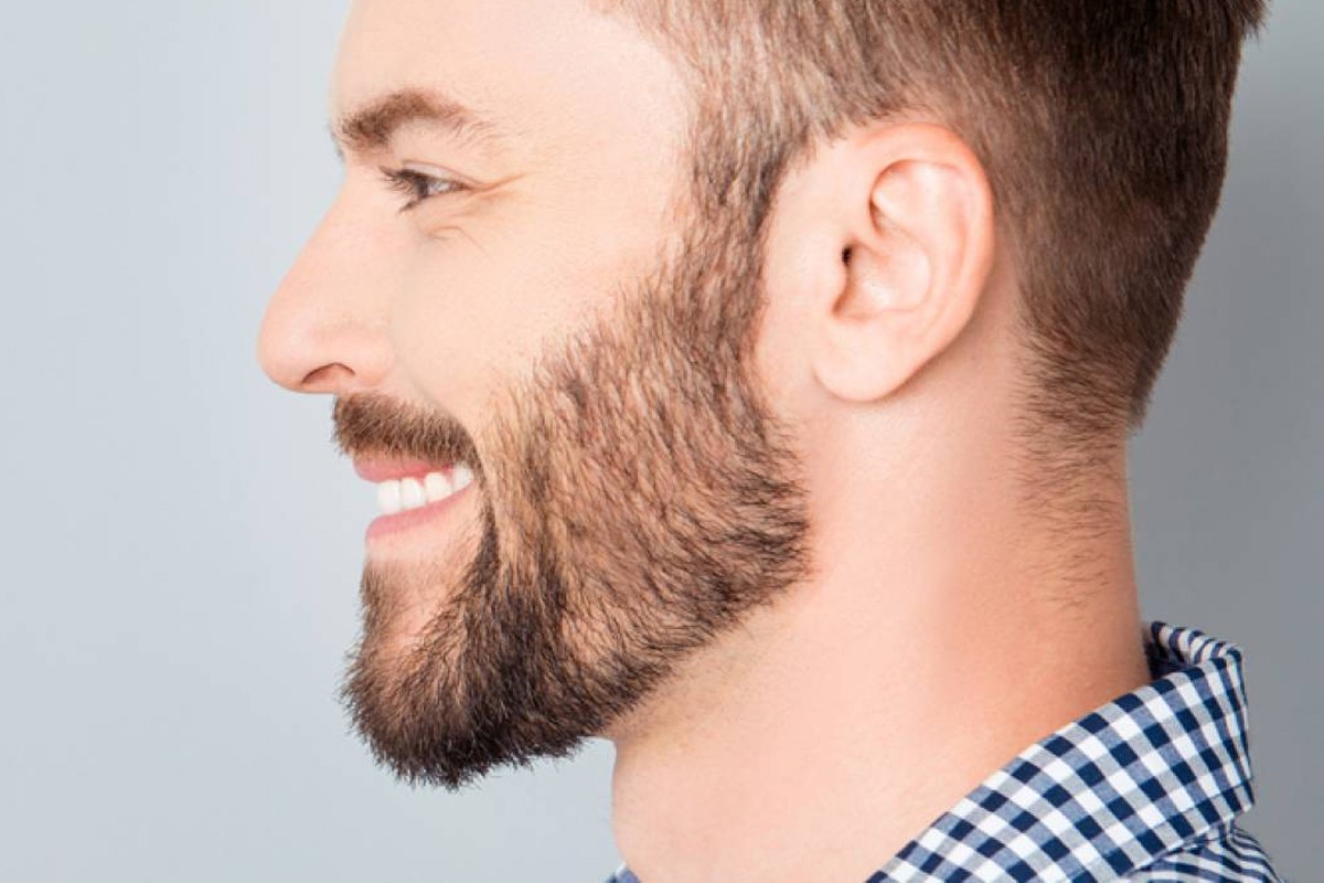 Profile of a young man with a thicker beard after facial hair transplant (beard restoration)