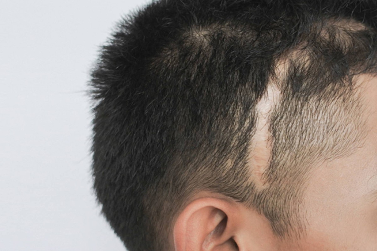 Close-up of scalp with visible scar before hair transplant for scar revision and keloid treatment